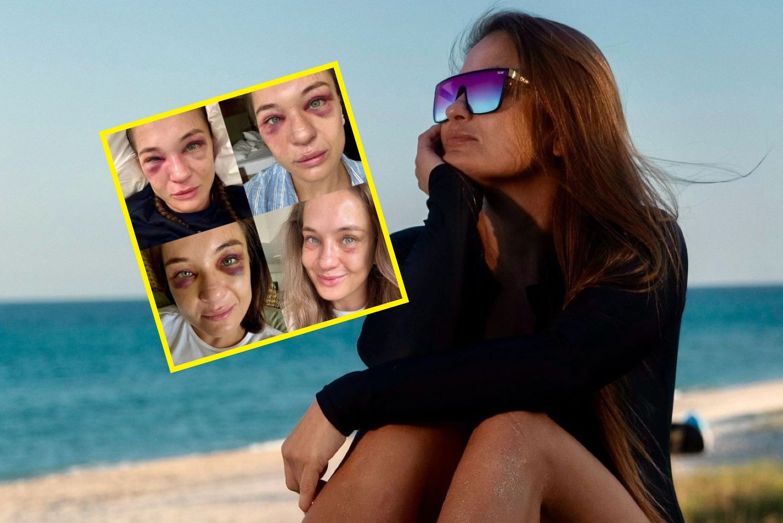 Minął tydzień od walki. Tak wygląda twarz Kowalkiewicz